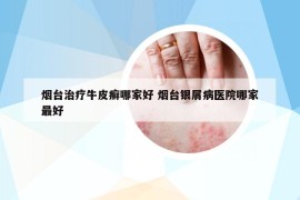 烟台治疗牛皮癣哪家好 烟台银屑病医院哪家最好