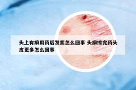 头上有癣用药后发紫怎么回事 头癣擦完药头皮更多怎么回事