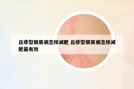 丘疹型银屑病怎样减肥 丘疹型银屑病怎样减肥最有效