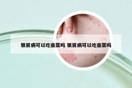 银屑病可以吃韭菜吗 银屑病可以吃韭菜吗