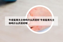 牛皮能用凡士林吗什么药膏好 牛皮能用凡士林吗什么药膏好呢