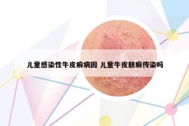 儿童感染性牛皮癣病因 儿童牛皮肤癣传染吗