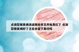 点滴型银屑病消退期皮疹又开始发红了 点滴型银屑病好了之后会留下黑印吗