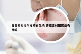 青霉素对治牛皮癣有效吗 青霉素对银屑病有用吗