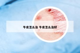 牛皮怎么治 牛皮怎么治好