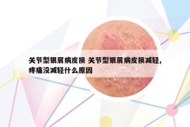 关节型银屑病皮损 关节型银屑病皮损减轻,疼痛没减轻什么原因