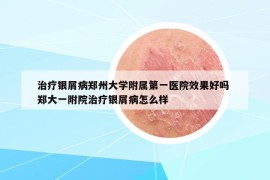 治疗银屑病郑州大学附属第一医院效果好吗 郑大一附院治疗银屑病怎么样