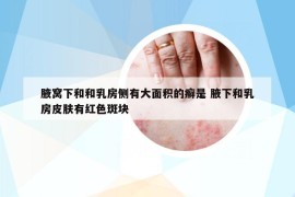 腋窝下和和乳房侧有大面积的癣是 腋下和乳房皮肤有红色斑块