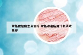 掌拓脓包病怎么治疗 掌拓浓泡疮用什么药效果好