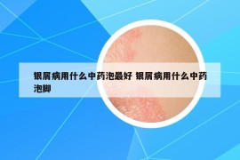 银屑病用什么中药泡最好 银屑病用什么中药泡脚