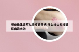 哪些维生素可以治疗银屑病 什么维生素对银屑病最有效