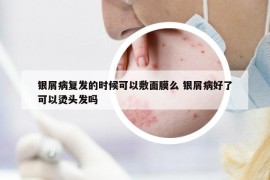 银屑病复发的时候可以敷面膜么 银屑病好了可以烫头发吗