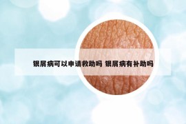 银屑病可以申请救助吗 银屑病有补助吗