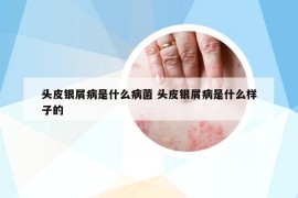 头皮银屑病是什么病菌 头皮银屑病是什么样子的