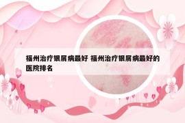 福州治疗银屑病最好 福州治疗银屑病最好的医院排名