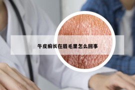 牛皮癣长在眉毛里怎么回事