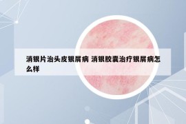 消银片治头皮银屑病 消银胶囊治疗银屑病怎么样