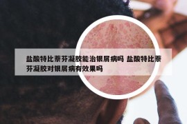 盐酸特比萘芬凝胶能治银屑病吗 盐酸特比萘芬凝胶对银屑病有效果吗