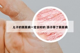 儿子的银屑病一定会好的 孩子得了银屑病