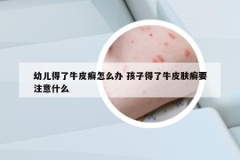 幼儿得了牛皮癣怎么办 孩子得了牛皮肤癣要注意什么