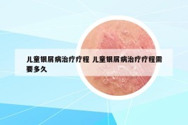 儿童银屑病治疗疗程 儿童银屑病治疗疗程需要多久