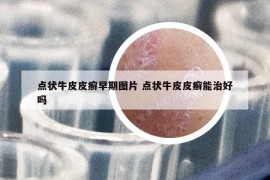 点状牛皮皮癣早期图片 点状牛皮皮癣能治好吗