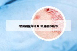 银屑病医学证明 银屑病诊断书