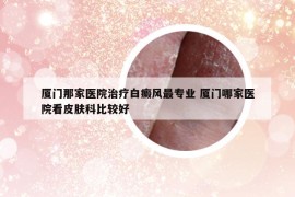 厦门那家医院治疗白癜风最专业 厦门哪家医院看皮肤科比较好