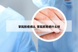 掌跖脓疱病么 掌跖脓疱病什么样