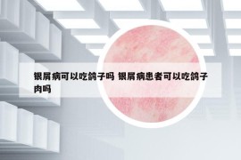 银屑病可以吃鸽子吗 银屑病患者可以吃鸽子肉吗