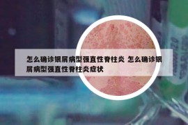 怎么确诊银屑病型强直性脊柱炎 怎么确诊银屑病型强直性脊柱炎症状