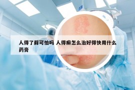 人得了藓可怕吗 人得癣怎么治好得快用什么药膏