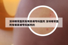 深圳哪家医院有银屑病专科医院 深圳哪家医院有银屑病专科医院的