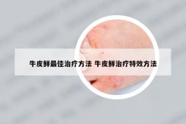 牛皮鲜最佳治疗方法 牛皮鲜治疗特效方法