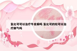 氢化可可以治疗牛皮癣吗 氢化可的松可以治疗脚气吗