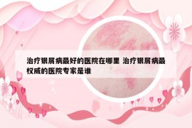 治疗银屑病最好的医院在哪里 治疗银屑病最权威的医院专家是谁