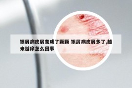 银屑病皮屑变成了颗颗 银屑病皮屑多了,越来越痒怎么回事