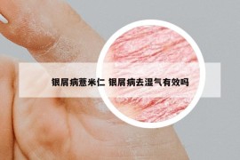 银屑病薏米仁 银屑病去湿气有效吗