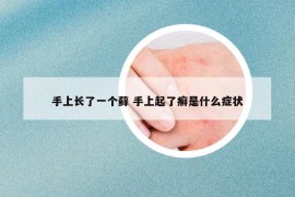 手上长了一个藓 手上起了癣是什么症状