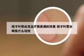 桔子叶熬水洗治疗银屑病的效果 桔子叶煮水喝有什么功效