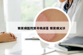 银屑病医院需寻杨淑莲 银屑病义诊