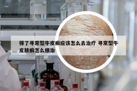 得了寻常型牛皮癣应该怎么去治疗 寻常型牛皮肤癣怎么根治