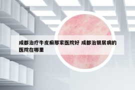 成都治疗牛皮癣那家医院好 成都治银屑病的医院在哪里