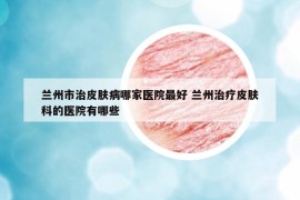 兰州市治皮肤病哪家医院最好 兰州治疗皮肤科的医院有哪些