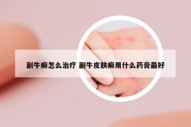 副牛癣怎么治疗 副牛皮肤癣用什么药膏最好