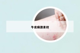 牛皮癣激素纹