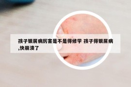 孩子银屑病厉害是不是得修学 孩子得银屑病,快崩溃了