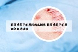 银屑病留下的黑印怎么消除 银屑病留下的黑印怎么消除掉