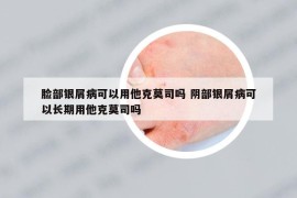 脸部银屑病可以用他克莫司吗 阴部银屑病可以长期用他克莫司吗