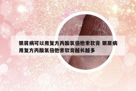 银屑病可以用复方丙酸氯倍他索软膏 银屑病用复方丙酸氯倍他索软膏越长越多